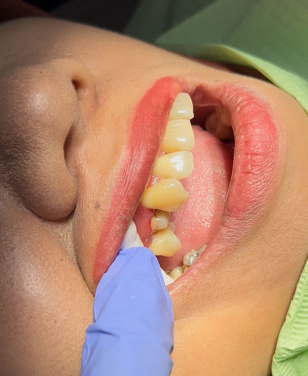 Sebelum: Pemasangan Crown / Jaket Gigi (Pelindung) Gigi Belakang