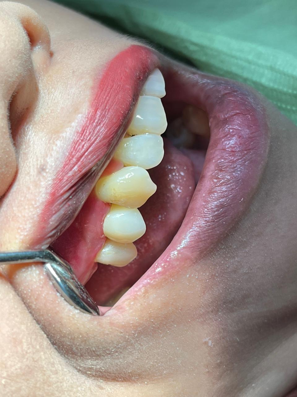 Sesudah: Pemasangan Crown / Jaket Gigi (Pelindung) Gigi Belakang