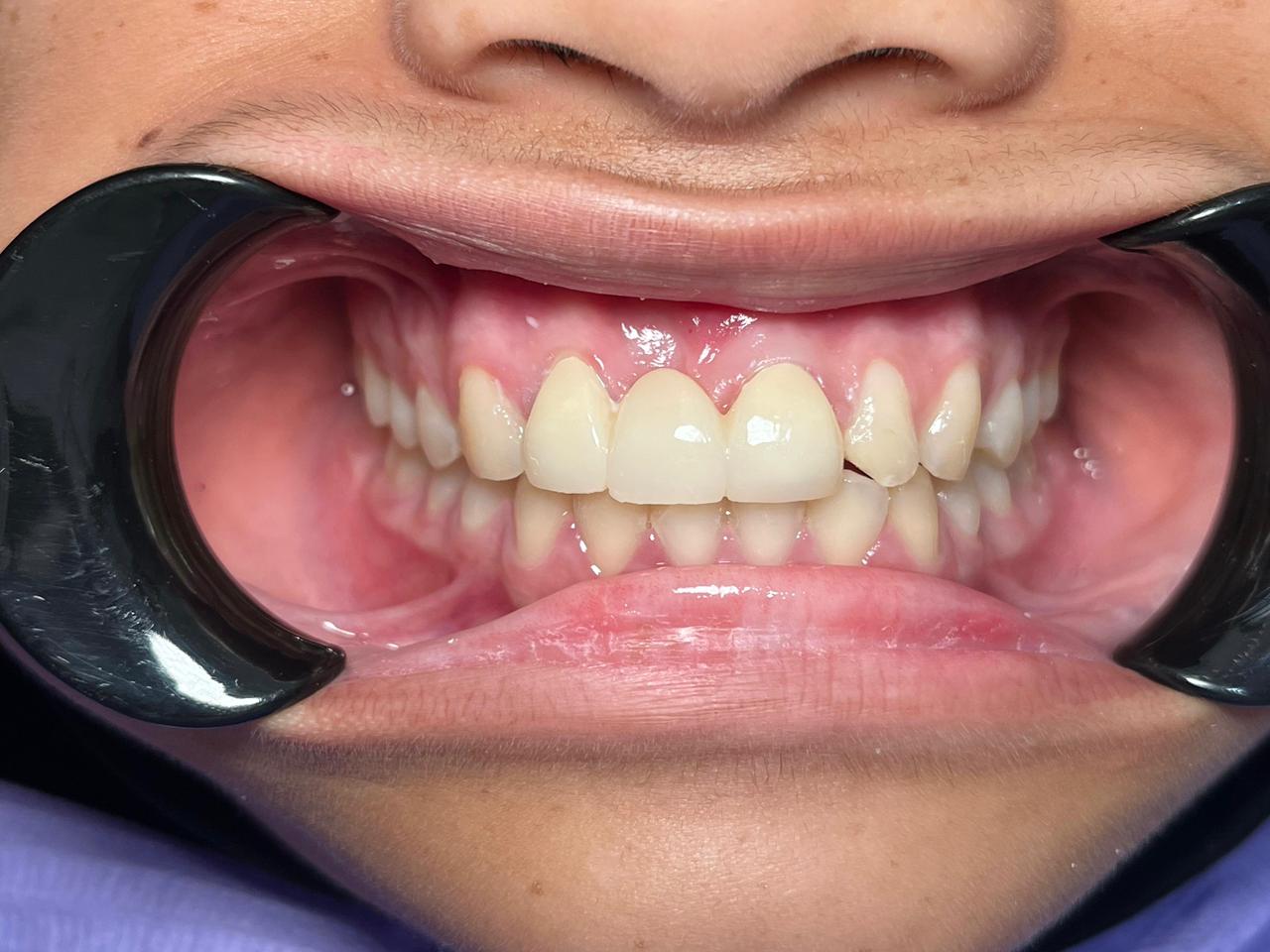 Sesudah: Pemasangan Bridge Gigi Depan Permanen Payakumbuh