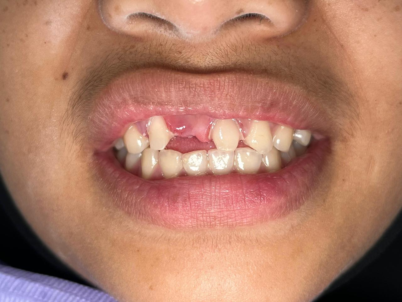 Sebelum: Pemasangan Bridge Gigi Depan Permanen Payakumbuh