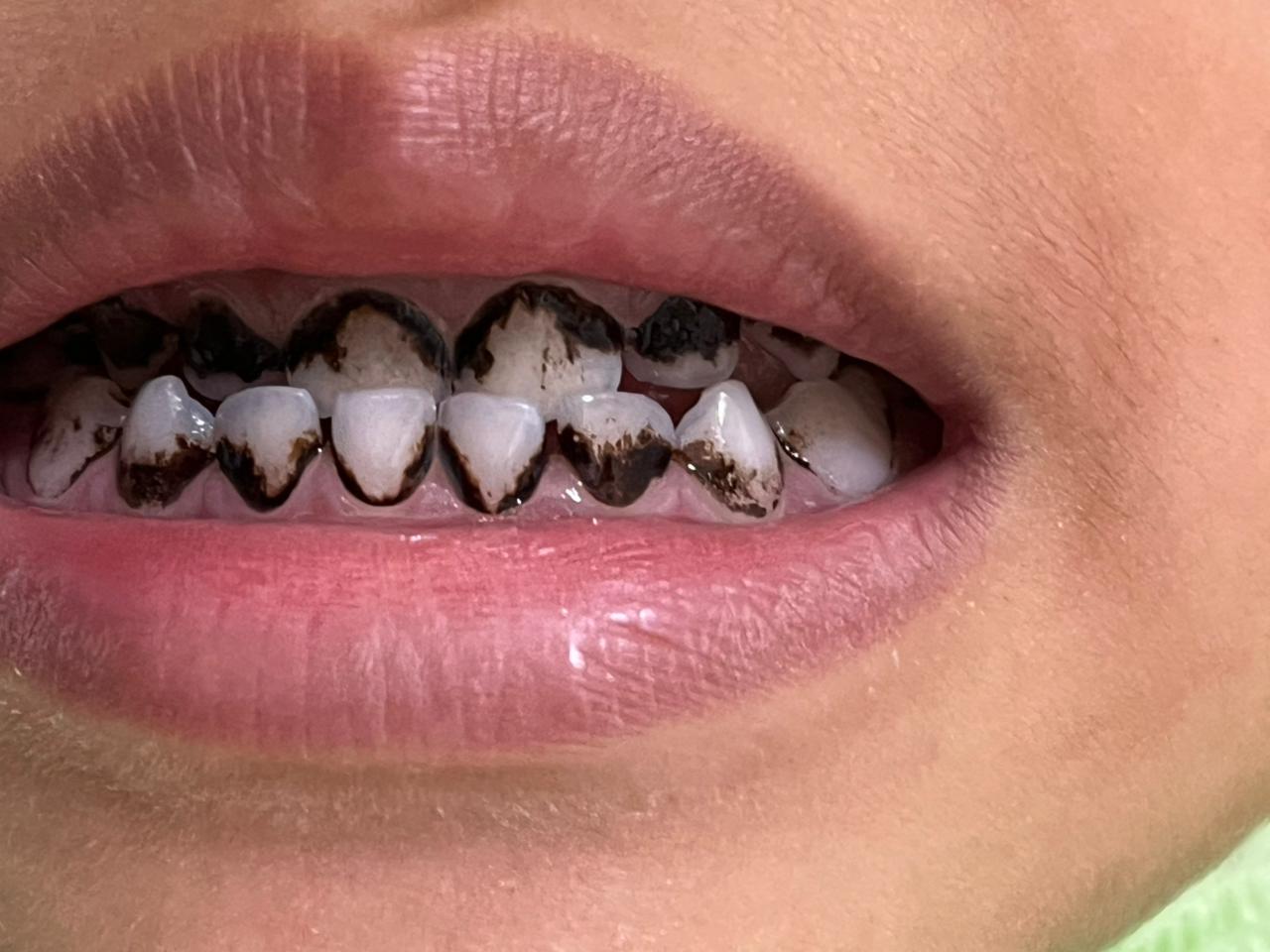 Sebelum: Scaling Gigi & Pembersihan Karang Gigi Profesional di Payakumbuh