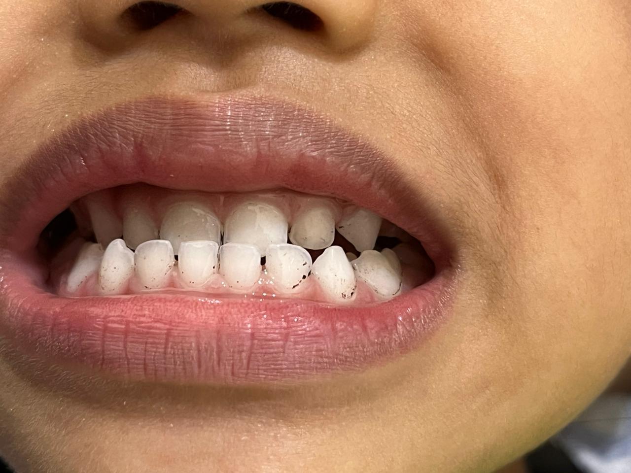 Sesudah: Scaling Gigi & Pembersihan Karang Gigi Profesional di Payakumbuh