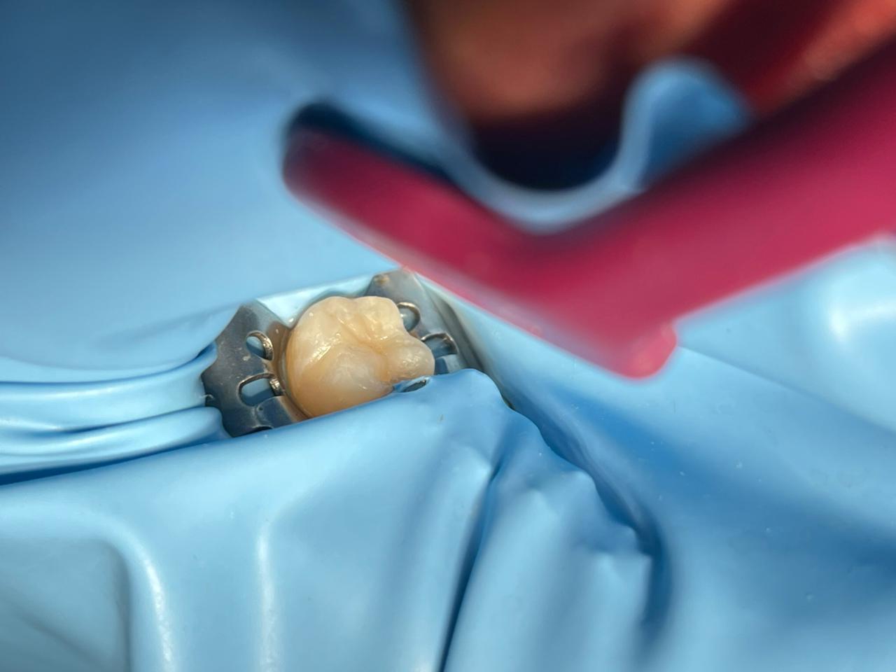 Sesudah: Tambal Gigi Resin Komposit Tahan Lama untuk Gigi Belakang