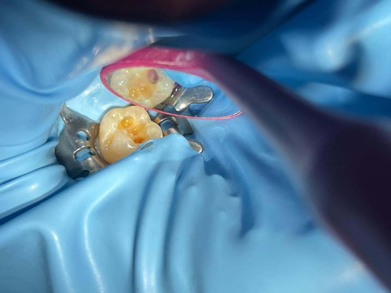 Sebelum: Tambal Gigi Resin Komposit Tahan Lama untuk Gigi Belakang