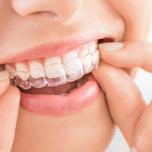 Aligner