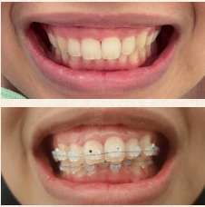 Behel Ceramic
